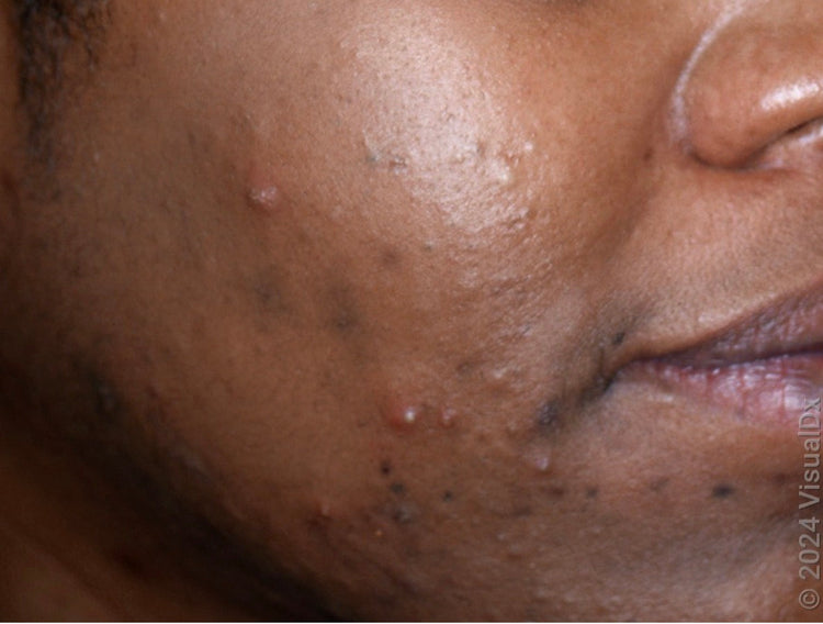 Acne & Breakouts