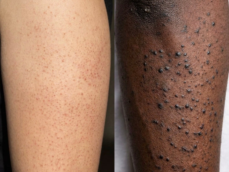 Keratosis Pilaris (KP) Treatment